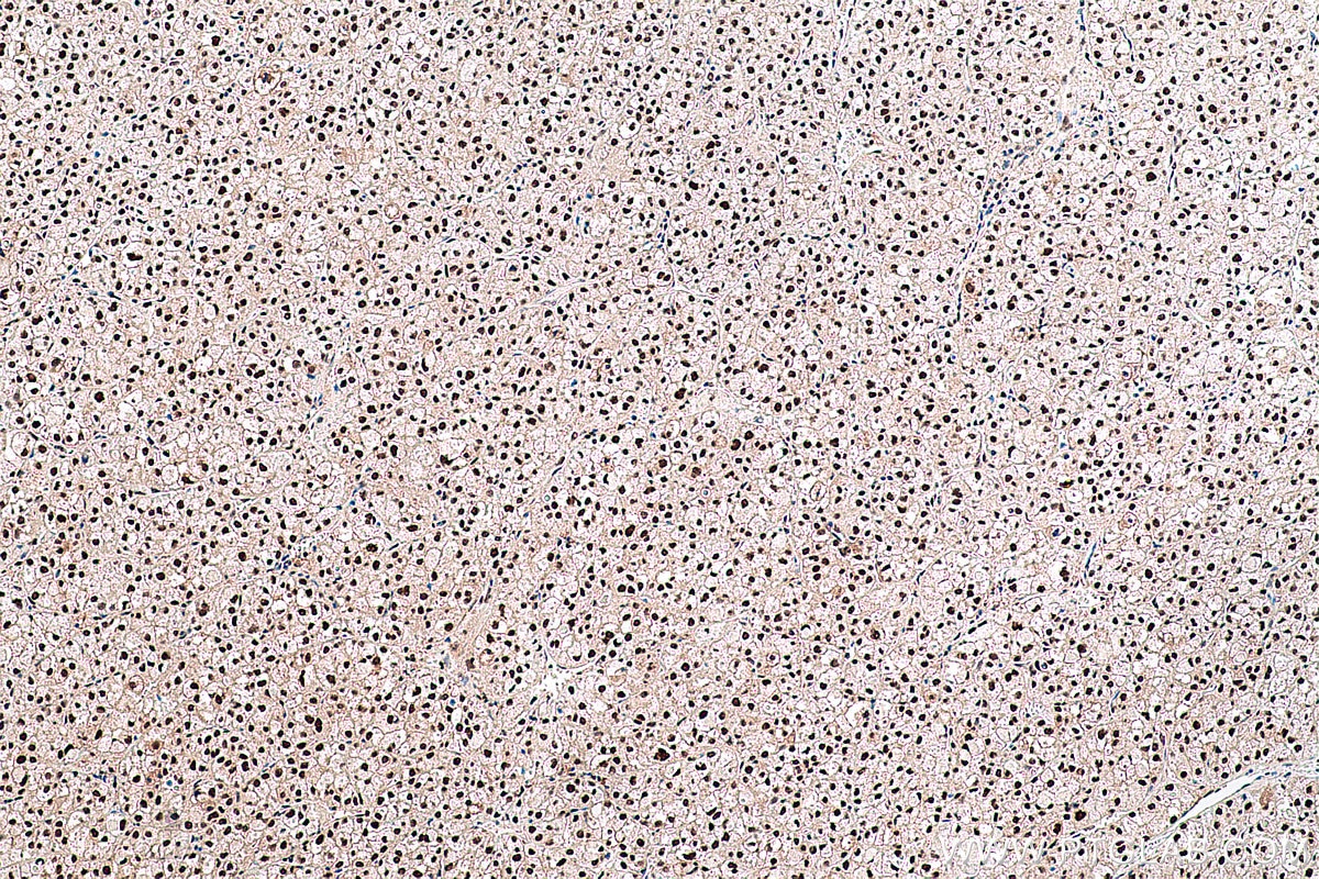 Immunohistochemical analysis of paraffin-embedded human liver cancer tissue slide using KHC0418 (FKBP5 IHC Kit).