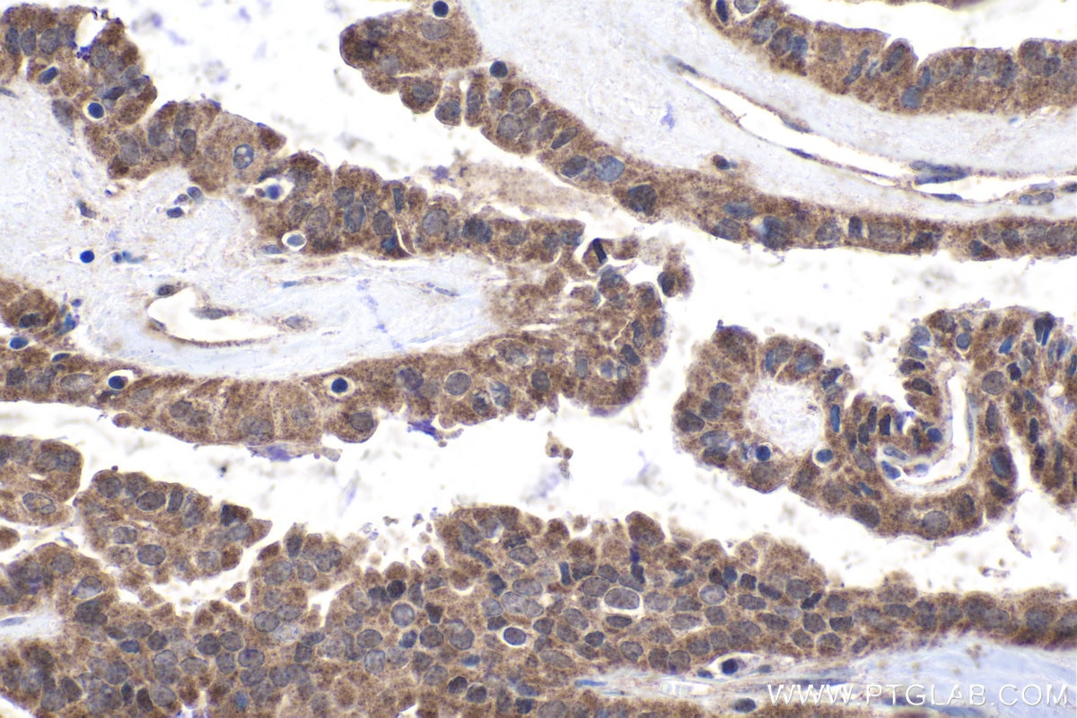 Immunohistochemical analysis of paraffin-embedded human thyroid cancer tissue slide using KHC1839 (FLCN IHC Kit).