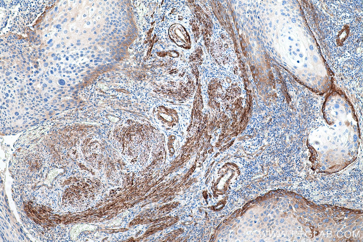 Immunohistochemical analysis of paraffin-embedded human cervical cancer tissue slide using KHC0655 (FLNA IHC Kit).
