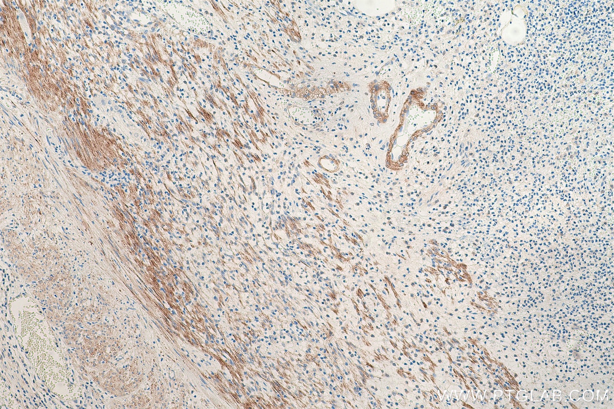 Immunohistochemical analysis of paraffin-embedded human appendicitis tissue slide using KHC0655 (FLNA IHC Kit).