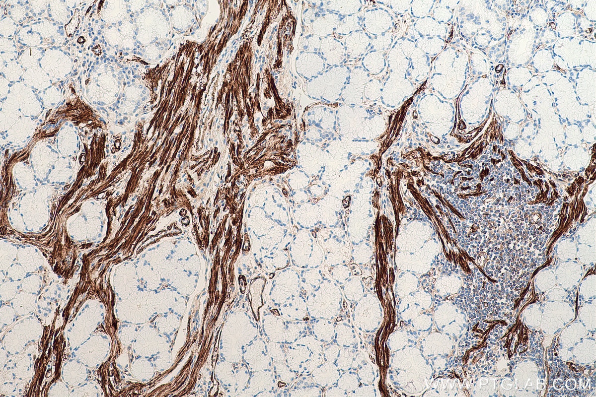 Immunohistochemical analysis of paraffin-embedded human stomach cancer tissue slide using KHC0655 (FLNA IHC Kit).