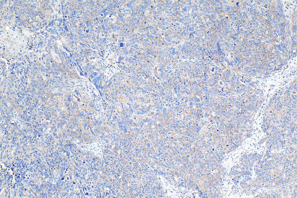 Immunohistochemical analysis of paraffin-embedded human ovary tumor tissue slide using KHC1072 (FLOT1 IHC Kit).