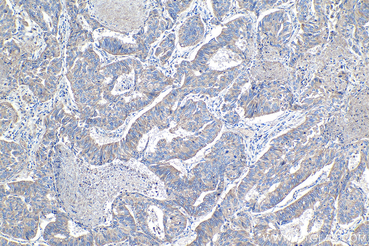 Immunohistochemical analysis of paraffin-embedded human lung cancer tissue slide using KHC1072 (FLOT1 IHC Kit).
