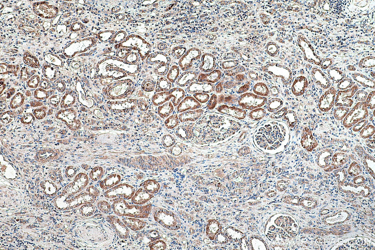 Immunohistochemical analysis of paraffin-embedded human renal cell carcinoma tissue slide using KHC0217 (VEGFR-1/FLT-1 IHC Kit).