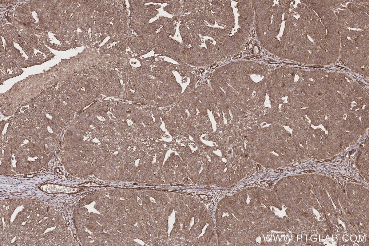 Immunohistochemical analysis of paraffin-embedded human ovary cancer tissue slide using KHC2646 (FMNL3 IHC Kit).