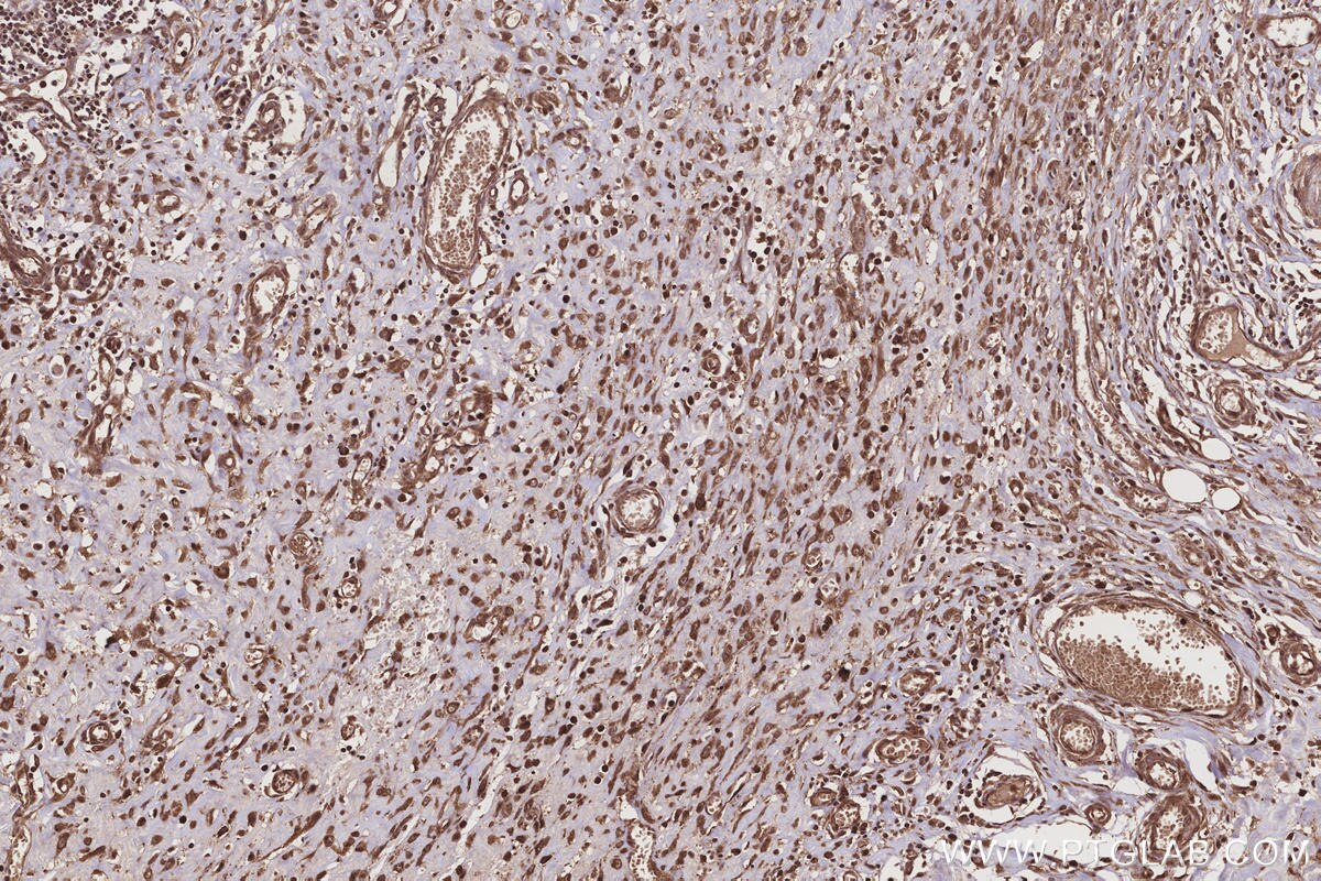 Immunohistochemical analysis of paraffin-embedded human colon cancer tissue slide using KHC3216 (FNTA IHC Kit). Immunohistochemical analysis of paraffin-embedded human colon cancer tissue slide using KHC3216 (FNTA IHC Kit).