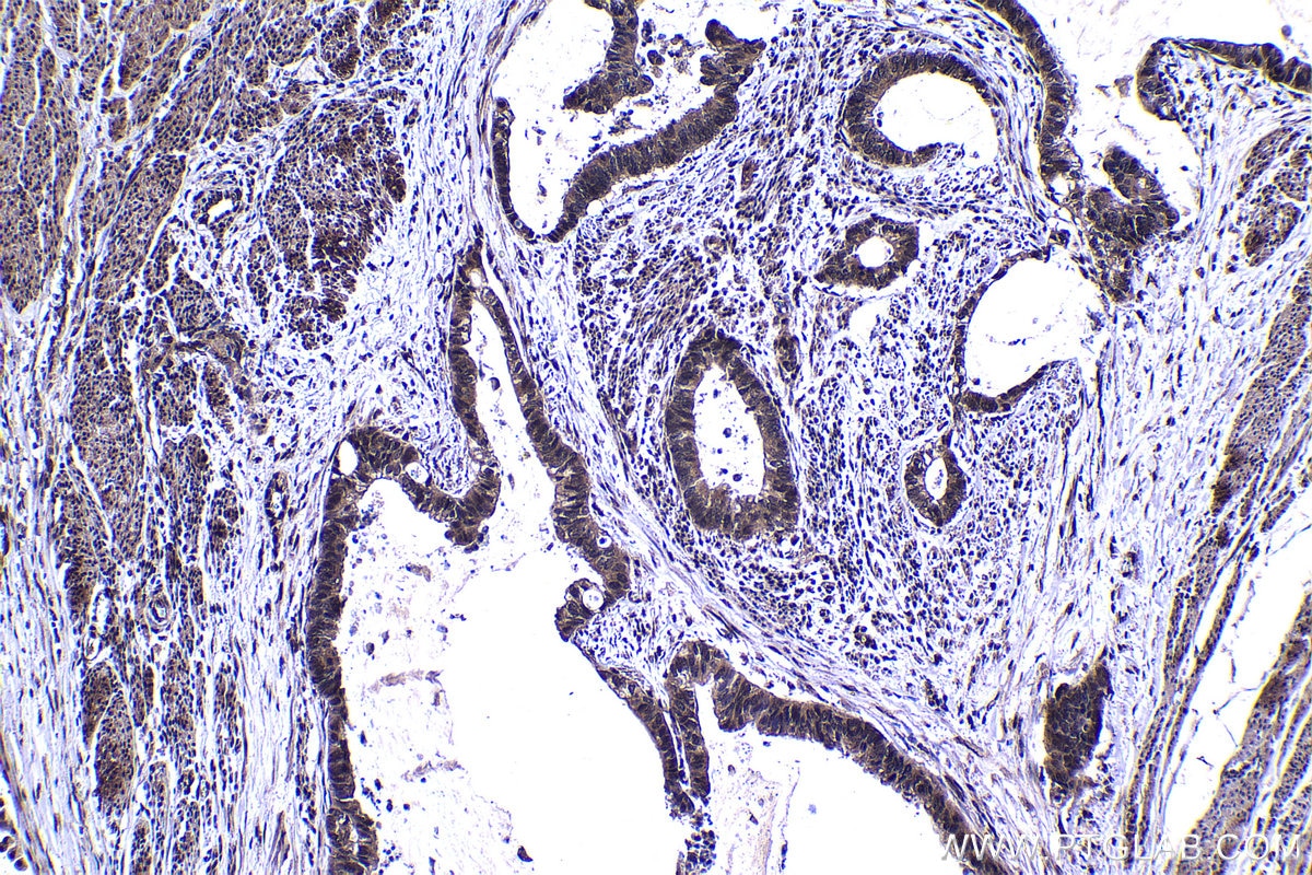 Immunohistochemical analysis of paraffin-embedded human urothelial carcinoma tissue slide using KHC1451 (FOX2/RBM9 IHC Kit).