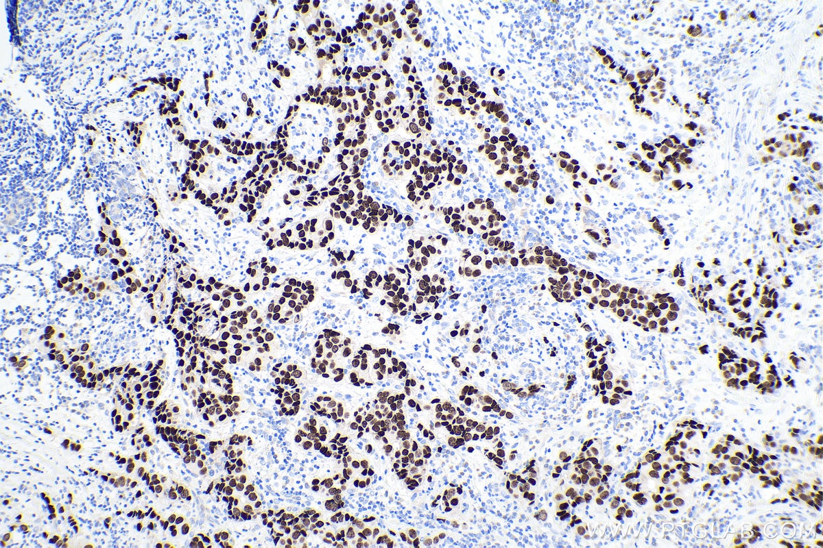 Immunohistochemical analysis of paraffin-embedded human breast cancer tissue slide using KHC0139 (FOXA1 IHC Kit).