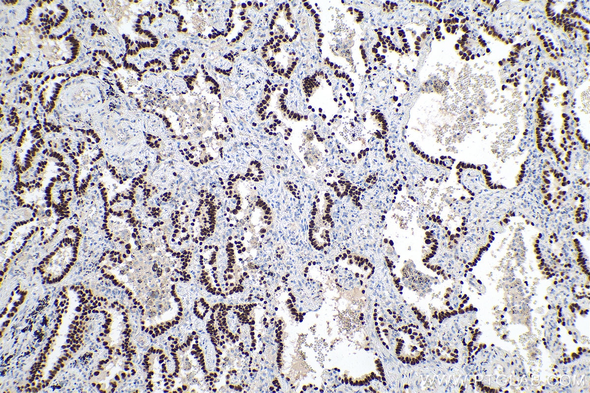 Immunohistochemical analysis of paraffin-embedded human lung cancer tissue slide using KHC0140 (FOXA2 IHC Kit).