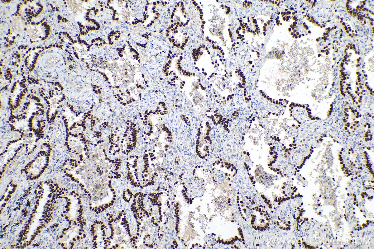 Immunohistochemical analysis of paraffin-embedded human lung cancer tissue slide using KHC0140 (FOXA2 IHC Kit).