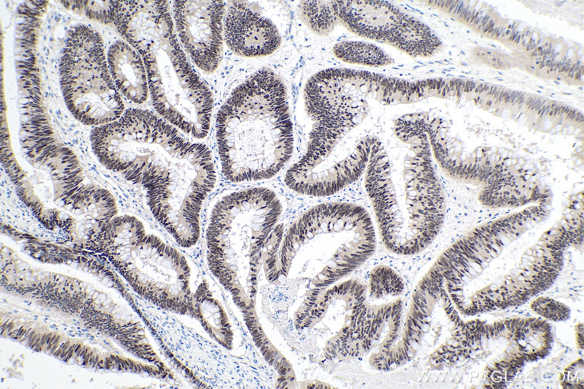 Immunohistochemical analysis of paraffin-embedded human colon cancer tissue slide using KHC0140 (FOXA2 IHC Kit).