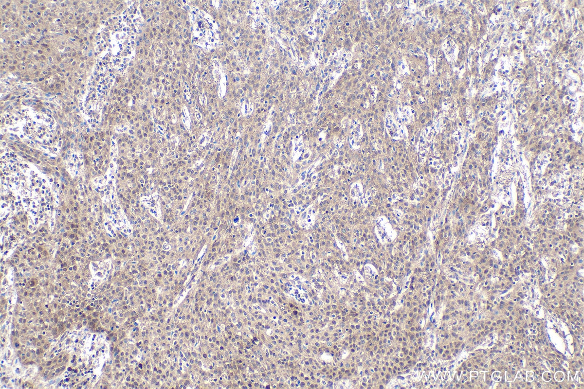 Immunohistochemical analysis of paraffin-embedded human cervical cancer tissue slide using KHC1663 (FOXK2 IHC Kit).