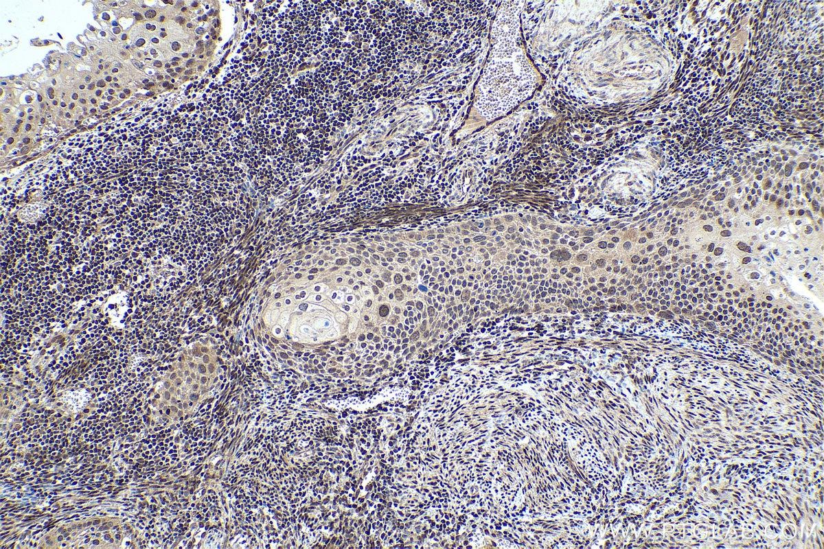 Immunohistochemical analysis of paraffin-embedded human cervical cancer tissue slide using KHC0328 (FOXO1 IHC Kit).