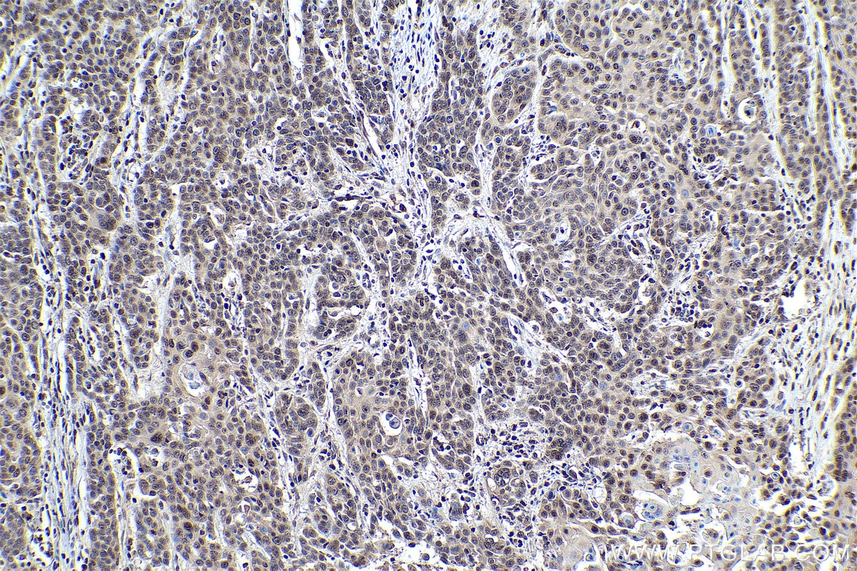Immunohistochemical analysis of paraffin-embedded human oesophagus cancer tissue slide using KHC0328 (FOXO1 IHC Kit).