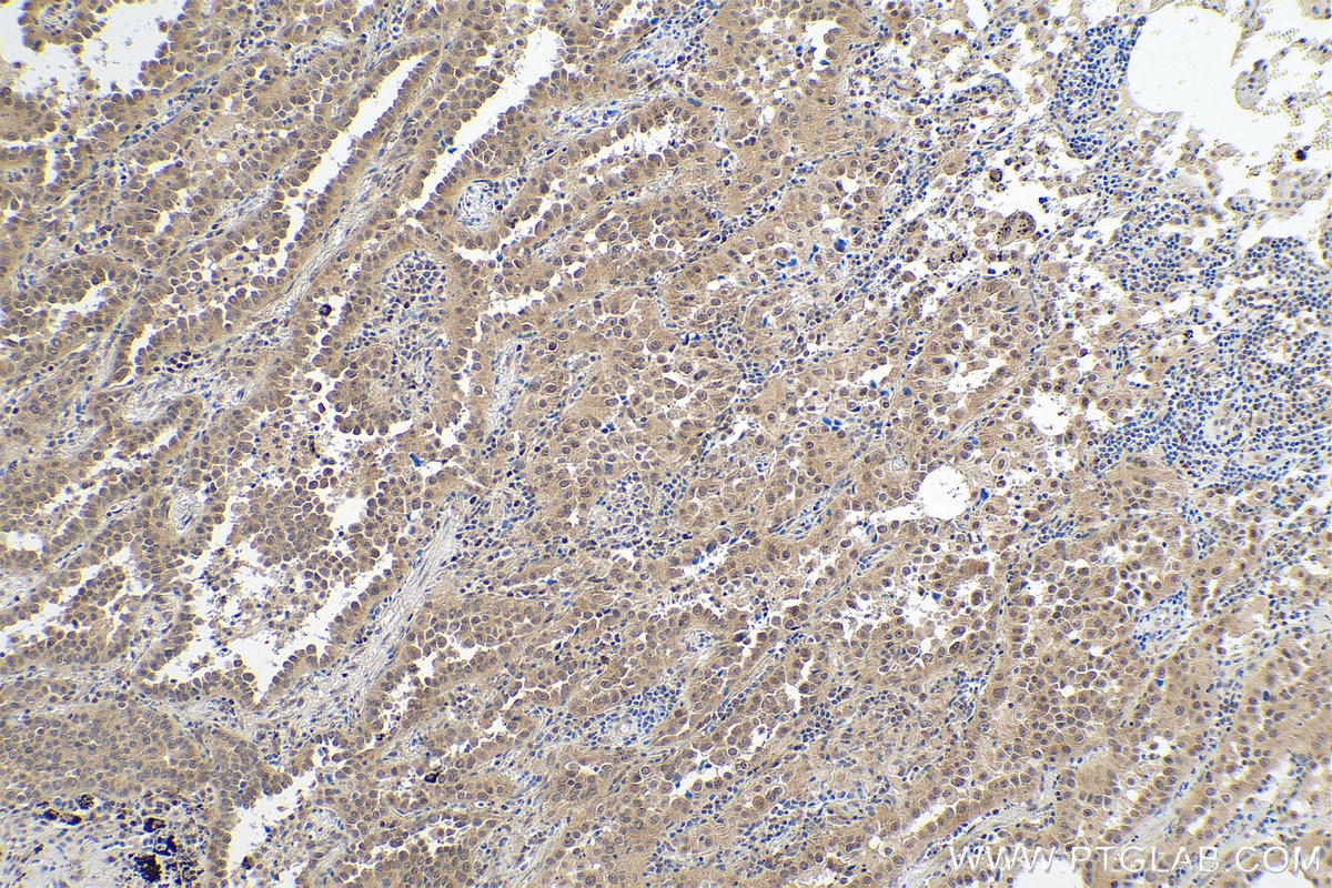 Immunohistochemical analysis of paraffin-embedded human lung cancer tissue slide using KHC0815 (FOXO3A IHC Kit).