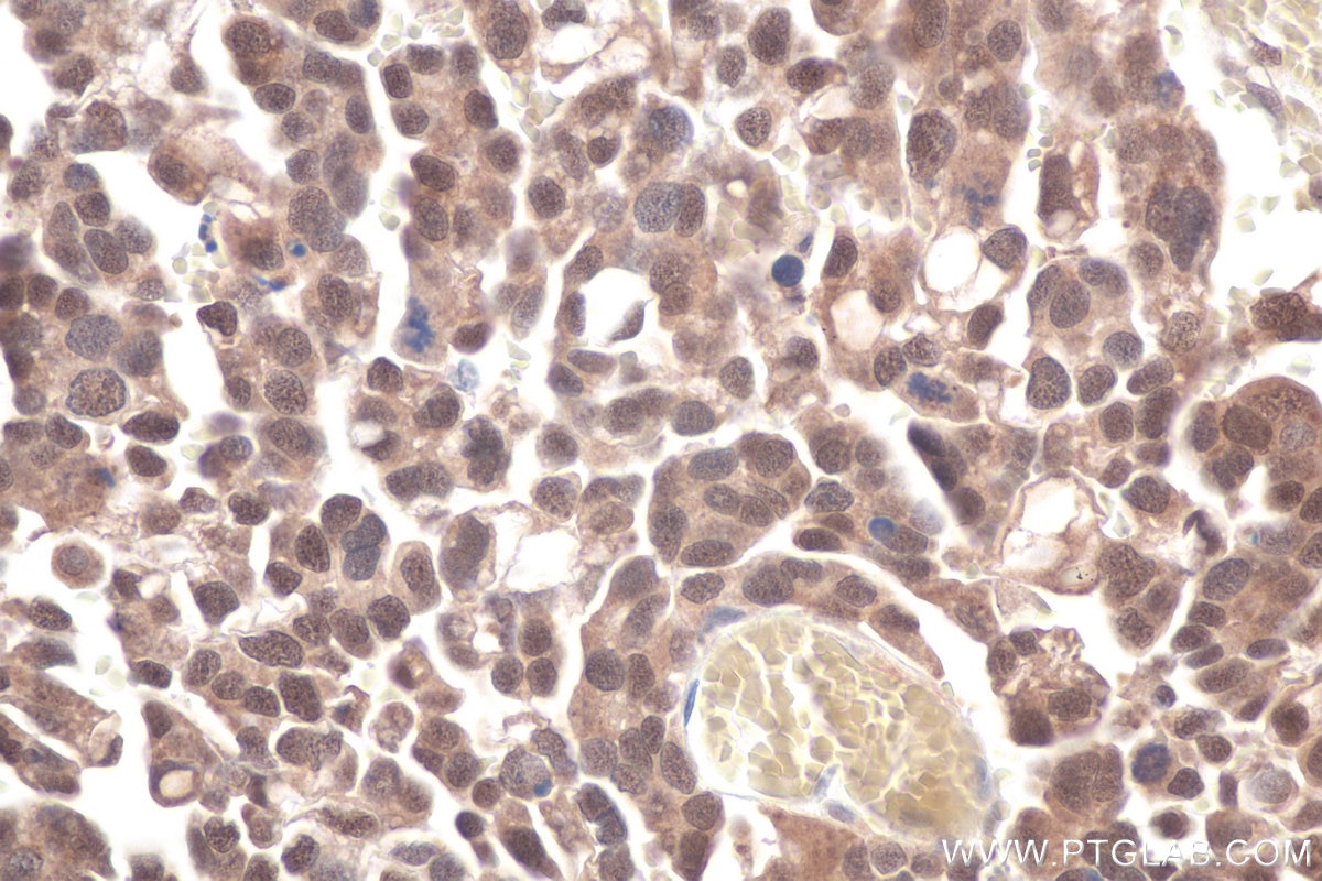Immunohistochemical analysis of paraffin-embedded human colon cancer tissue slide using KHC0815 (FOXO3A IHC Kit).