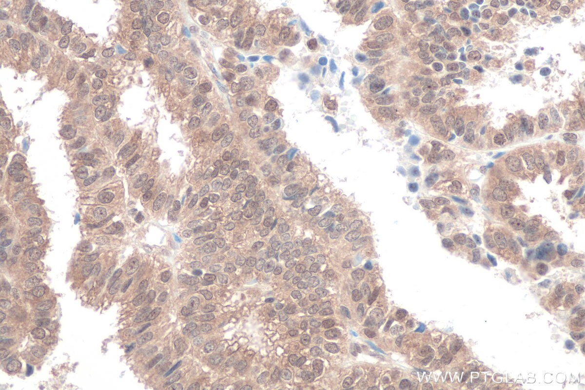 Immunohistochemical analysis of paraffin-embedded human ovary tumor tissue slide using KHC0815 (FOXO3A IHC Kit).