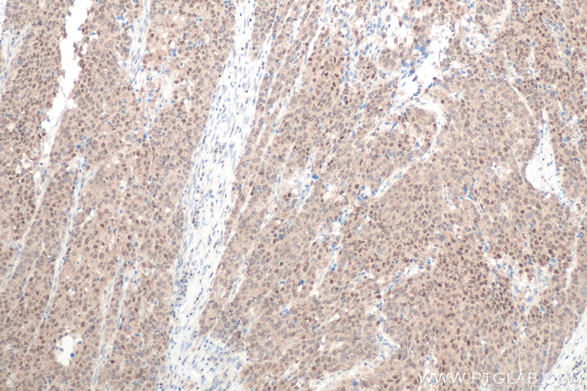 Immunohistochemical analysis of paraffin-embedded human stomach cancer tissue slide using KHC0815 (FOXO3A IHC Kit).