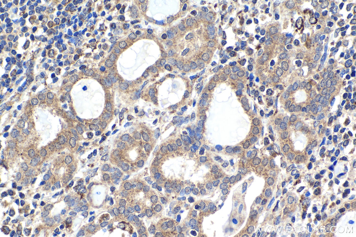 Immunohistochemical analysis of paraffin-embedded human thyroid cancer tissue slide using KHC1656 (FOXO4 IHC Kit).