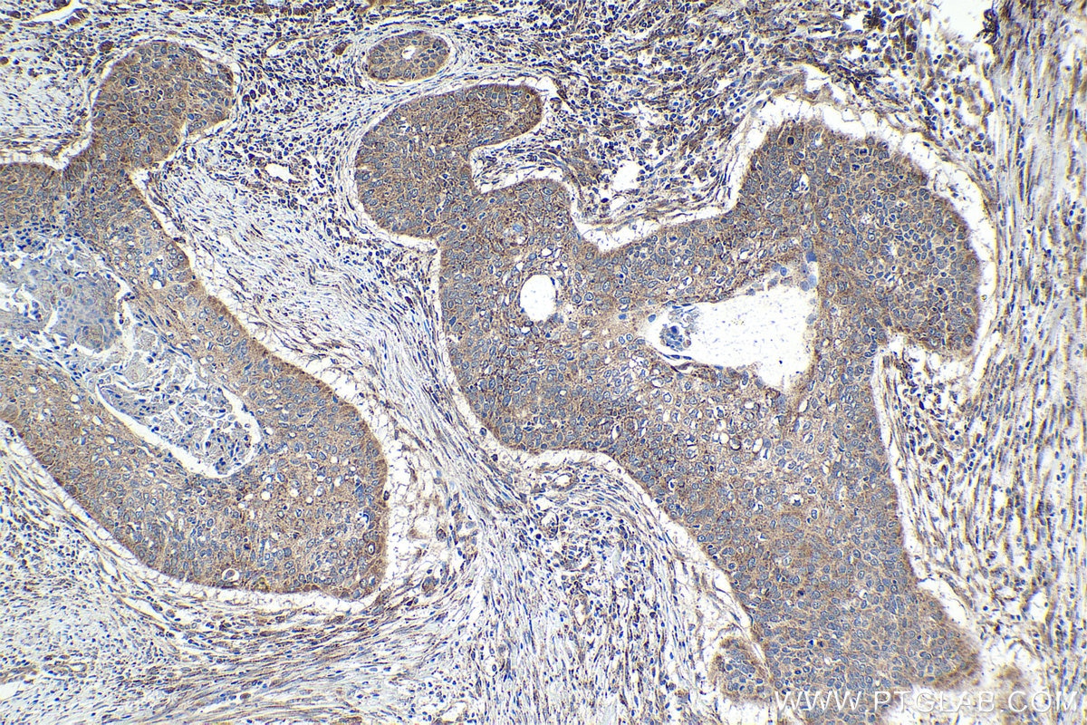 Immunohistochemical analysis of paraffin-embedded human oesophagus cancer tissue slide using KHC1656 (FOXO4 IHC Kit).