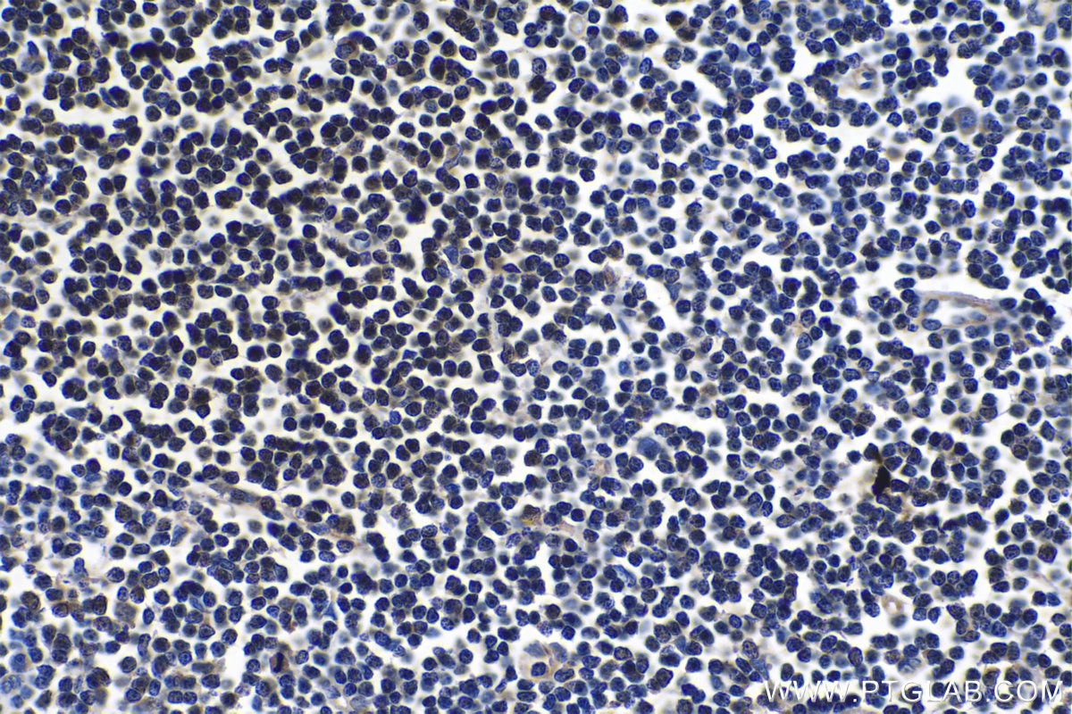 Immunohistochemical analysis of paraffin-embedded human lymphoma tissue slide using KHC1063 (FOXP1 IHC Kit).