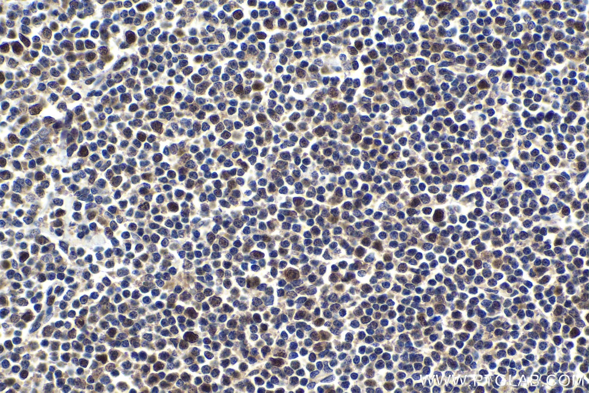 Immunohistochemical analysis of paraffin-embedded human lymphoma tissue slide using KHC1790 (FOXR1 IHC Kit).