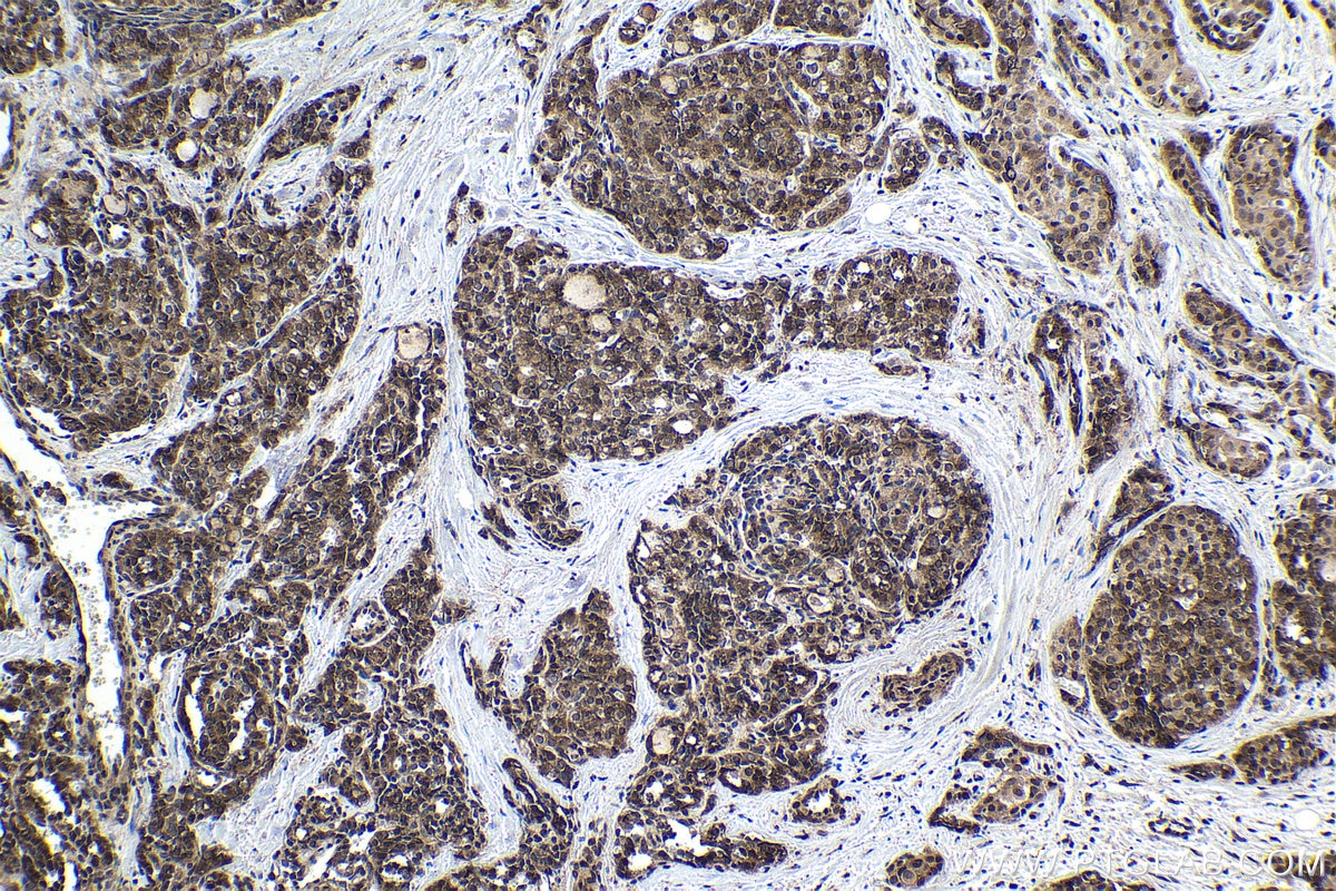 Immunohistochemical analysis of paraffin-embedded human thyroid cancer tissue slide using KHC1790 (FOXR1 IHC Kit).
