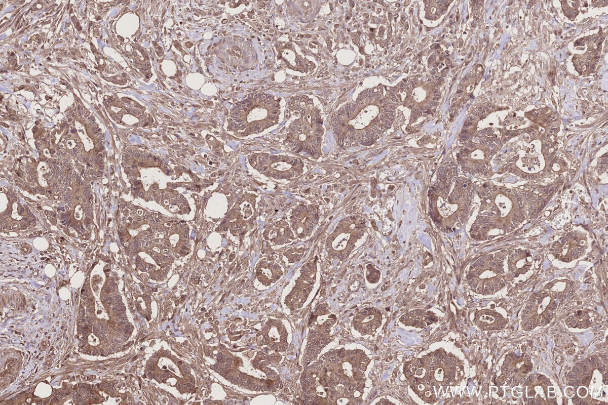 Immunohistochemical analysis of paraffin-embedded human rectal cancer tissue slide using KHC2731 (FRS2 IHC Kit).