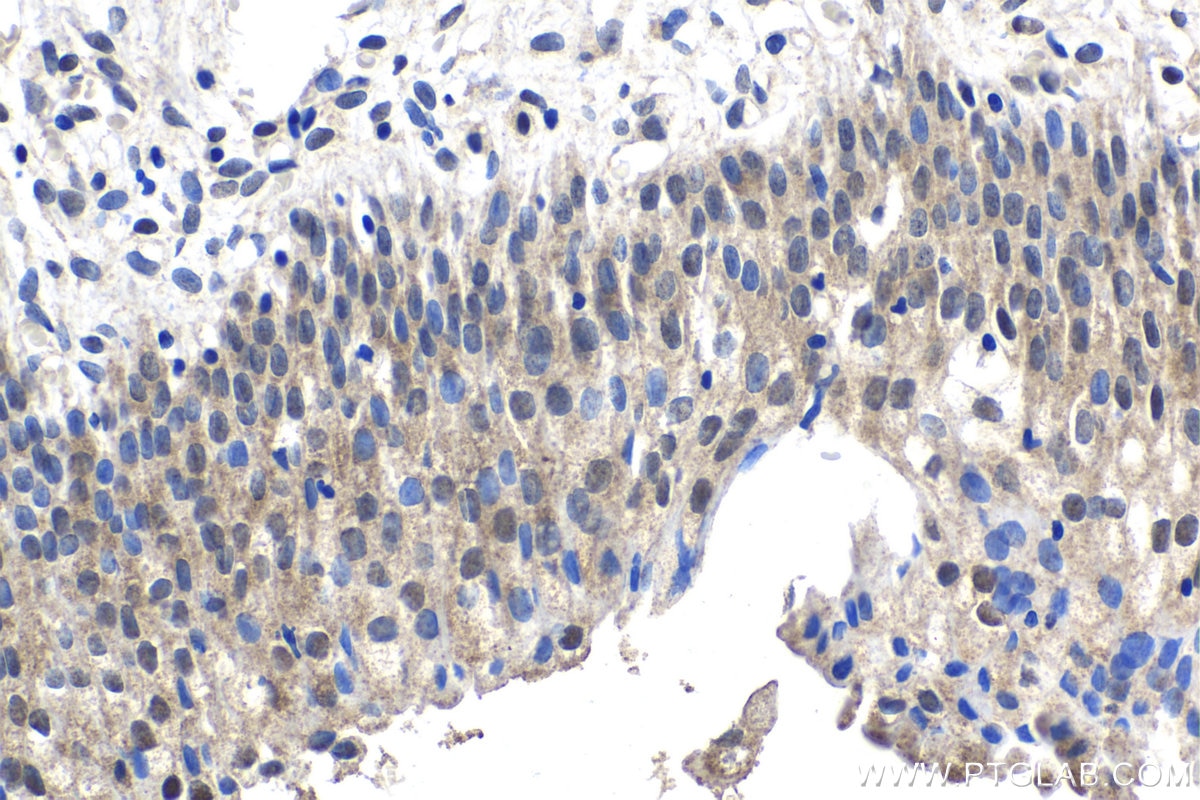 Immunohistochemical analysis of paraffin-embedded human urothelial carcinoma tissue slide using KHC1498 (FSTL3 IHC Kit).
