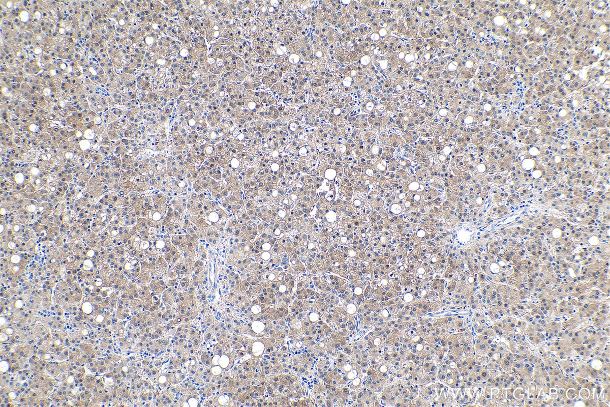 Immunohistochemical analysis of paraffin-embedded human liver cancer tissue slide using KHC0533 (FTCD IHC Kit).