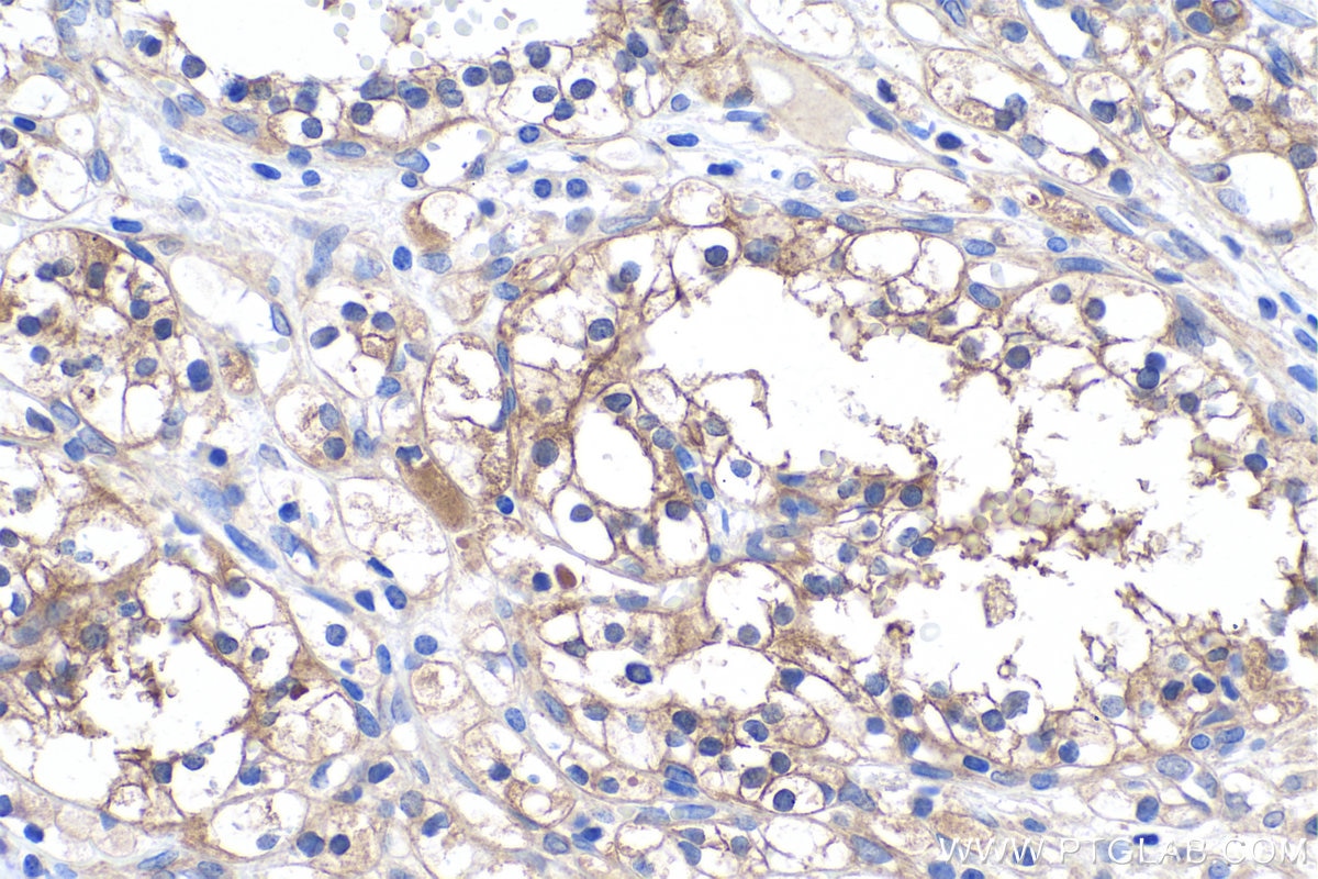 Immunohistochemical analysis of paraffin-embedded human renal cell carcinoma tissue slide using KHC0533 (FTCD IHC Kit).