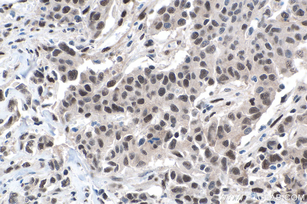 Immunohistochemical analysis of paraffin-embedded human stomach cancer tissue slide using KHC0153 (FTO IHC Kit).