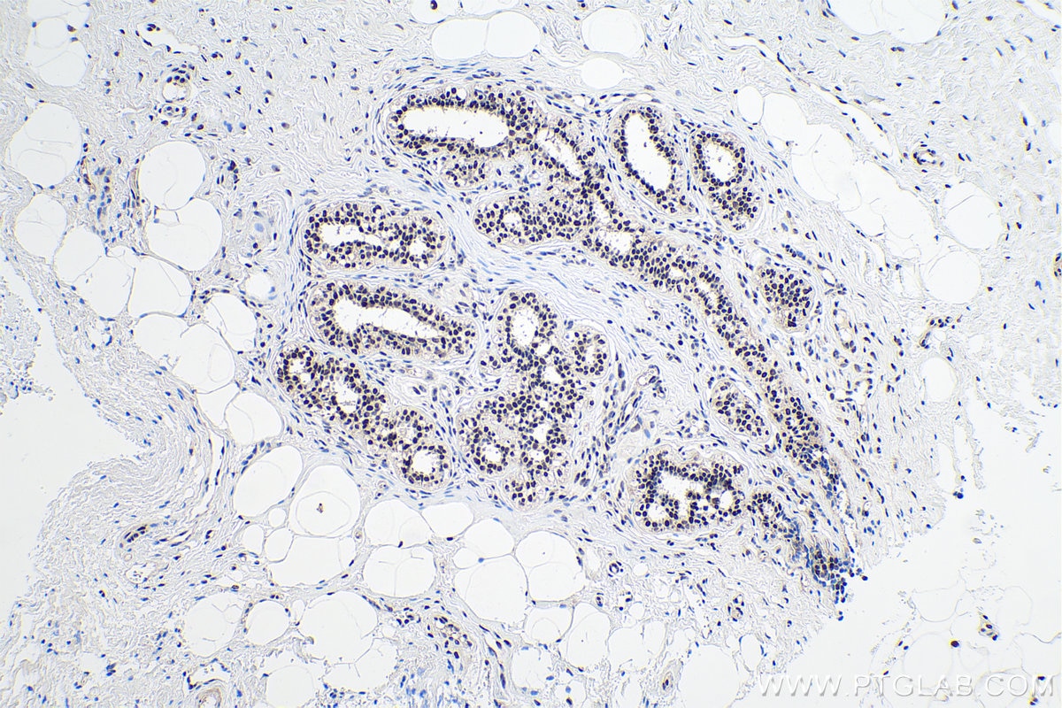 Immunohistochemical analysis of paraffin-embedded human breast cancer tissue slide using KHC0153 (FTO IHC Kit).