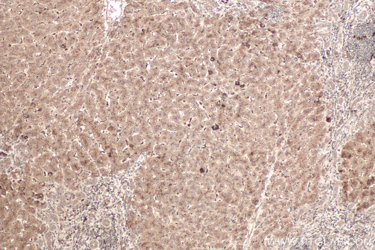 Immunohistochemical analysis of paraffin-embedded human liver cancer tissue slide using KHC0766 (FUCA1 IHC Kit).