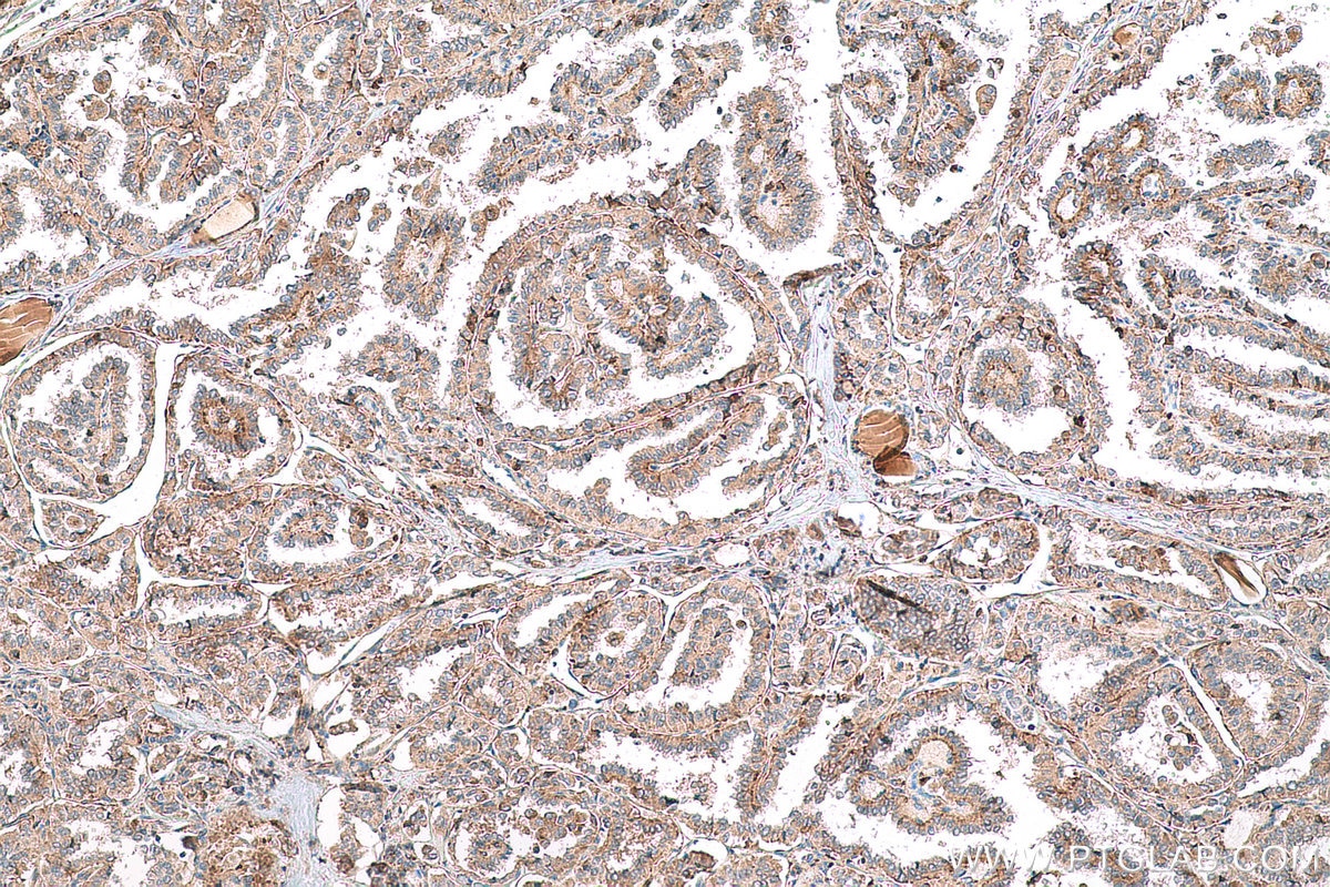 Immunohistochemical analysis of paraffin-embedded human thyroid cancer tissue slide using KHC0766 (FUCA1 IHC Kit).