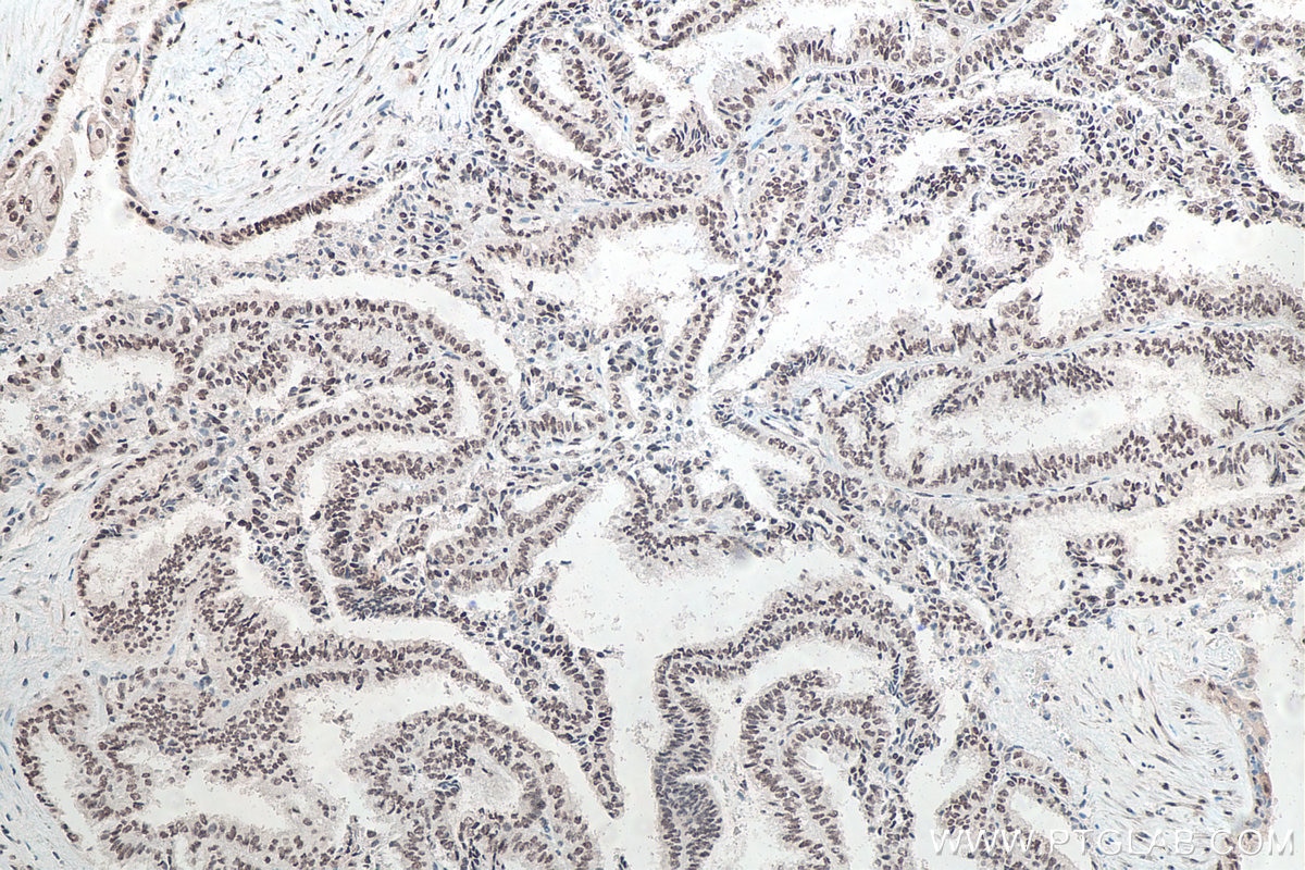 Immunohistochemical analysis of paraffin-embedded human ovary tumor tissue slide using KHC0057 (FUS/TLS IHC Kit).