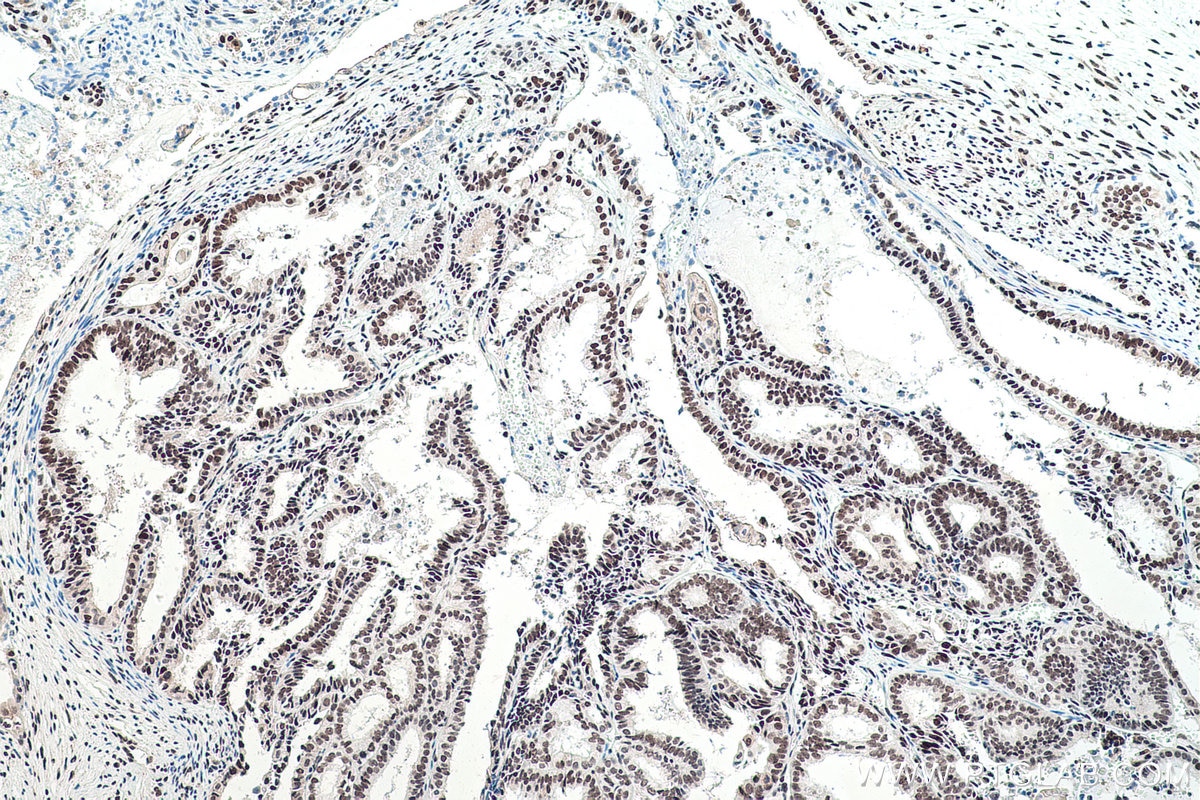 Immunohistochemical analysis of paraffin-embedded human ovary tumor tissue slide using KHC0057 (FUS/TLS IHC Kit).