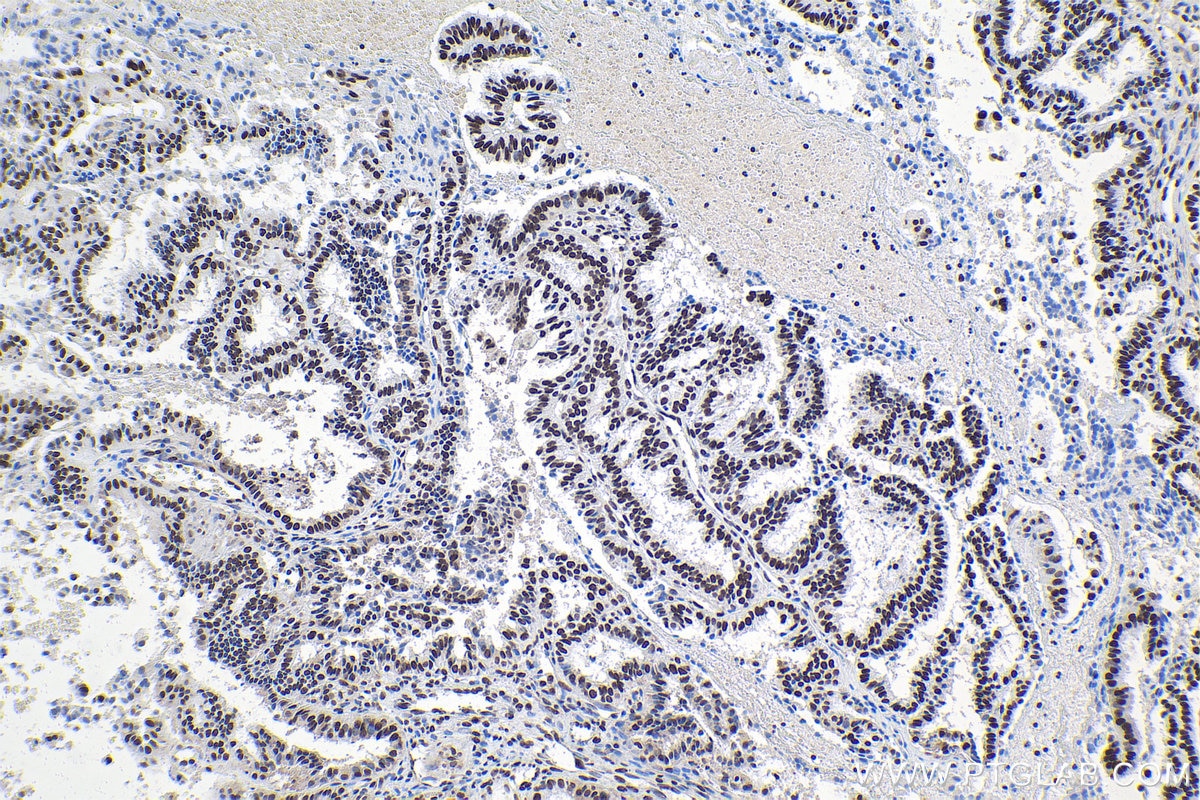 Immunohistochemical analysis of paraffin-embedded human ovary tumor tissue slide using KHC0937 (FUS/TLS IHC Kit).