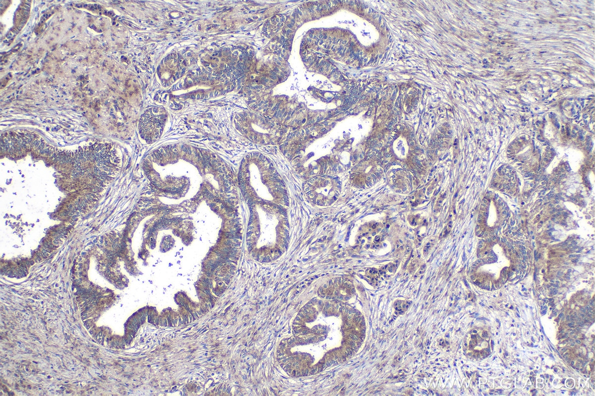 Immunohistochemical analysis of paraffin-embedded human pancreas cancer tissue slide using KHC1227 (FUT11 IHC Kit).