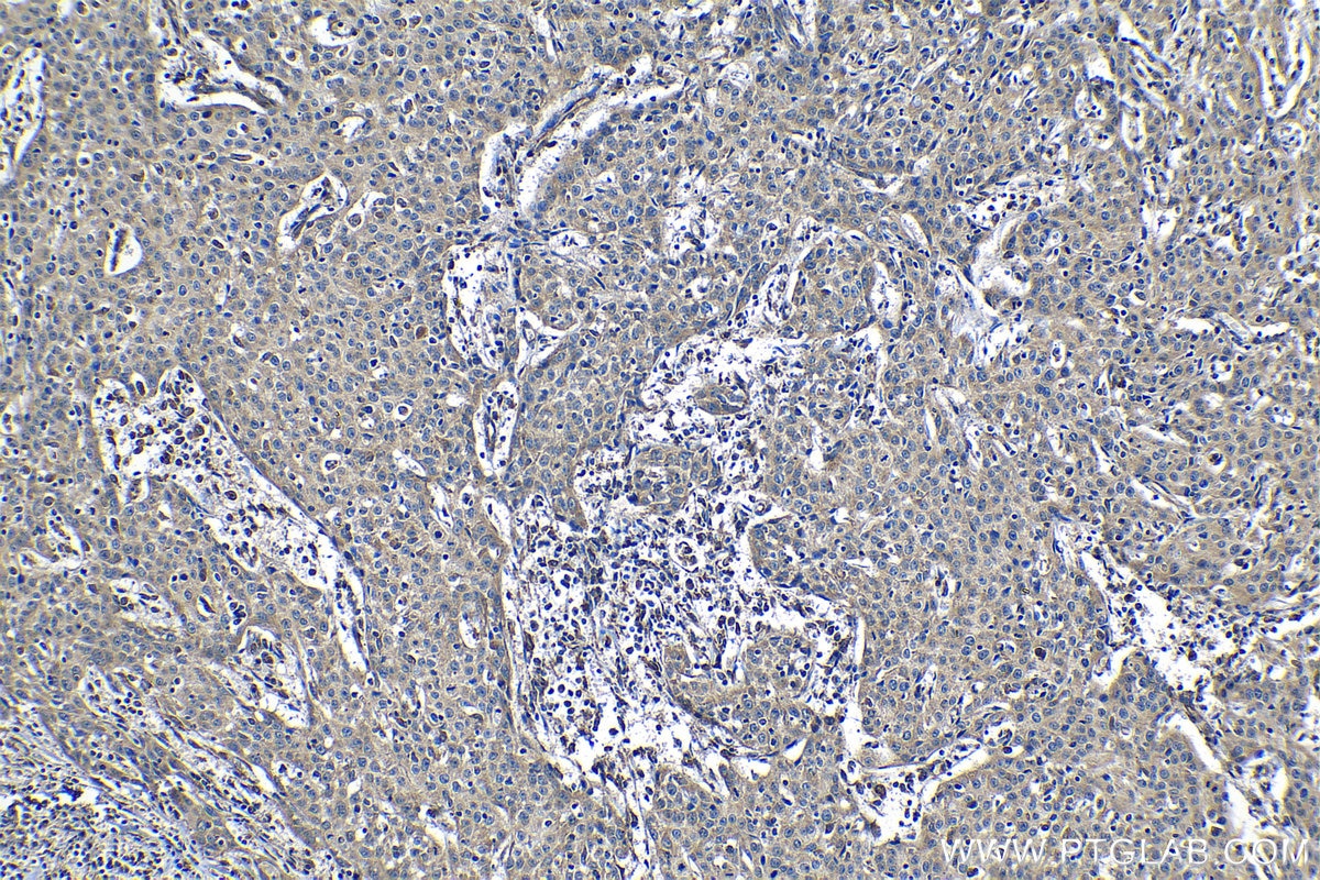 Immunohistochemical analysis of paraffin-embedded human cervical cancer tissue slide using KHC1227 (FUT11 IHC Kit).