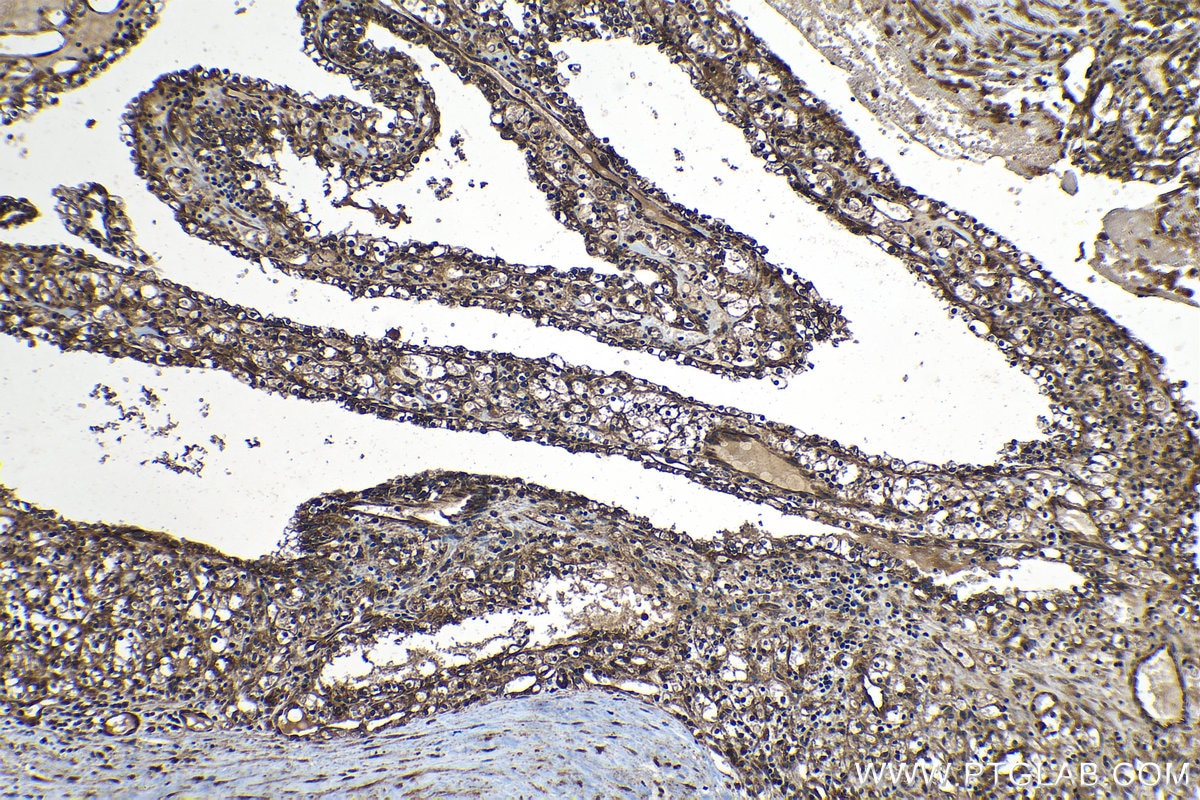 Immunohistochemical analysis of paraffin-embedded human renal cell carcinoma tissue slide using KHC1227 (FUT11 IHC Kit).