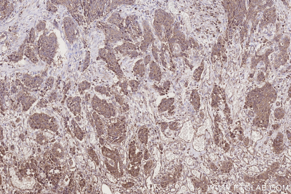 Immunohistochemical analysis of paraffin-embedded human stomach cancer tissue slide using KHC3273 (FUT8 IHC Kit). Immunohistochemical analysis of paraffin-embedded human stomach cancer tissue slide using KHC3273 (FUT8 IHC Kit).