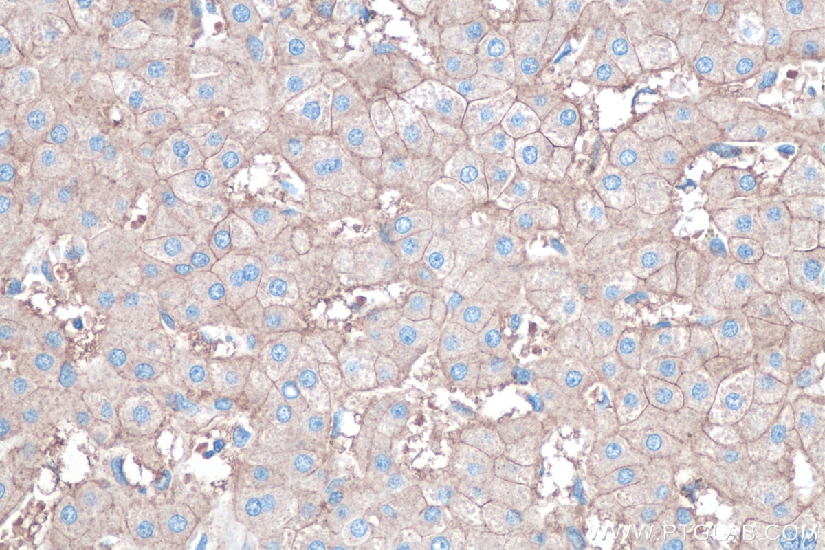 Immunohistochemical analysis of paraffin-embedded human liver cancer tissue slide using KHC0420 (FXYD1 IHC Kit).