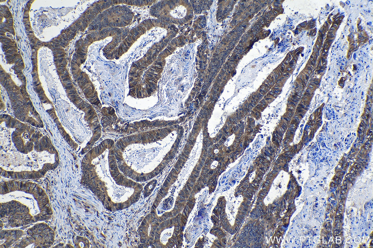 Immunohistochemical analysis of paraffin-embedded human colon cancer tissue slide using KHC1131 (FXYD5 IHC Kit).