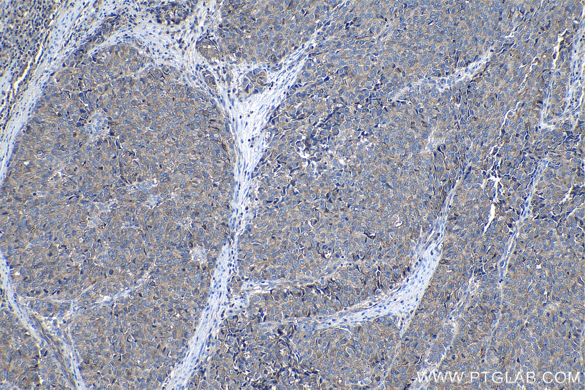 Immunohistochemical analysis of paraffin-embedded human stomach cancer tissue slide using KHC1131 (FXYD5 IHC Kit).