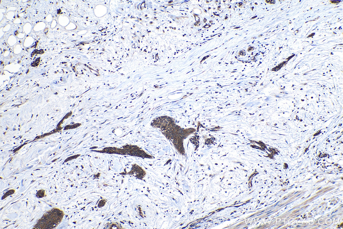 Immunohistochemical analysis of paraffin-embedded human urothelial carcinoma tissue slide using KHC1131 (FXYD5 IHC Kit).