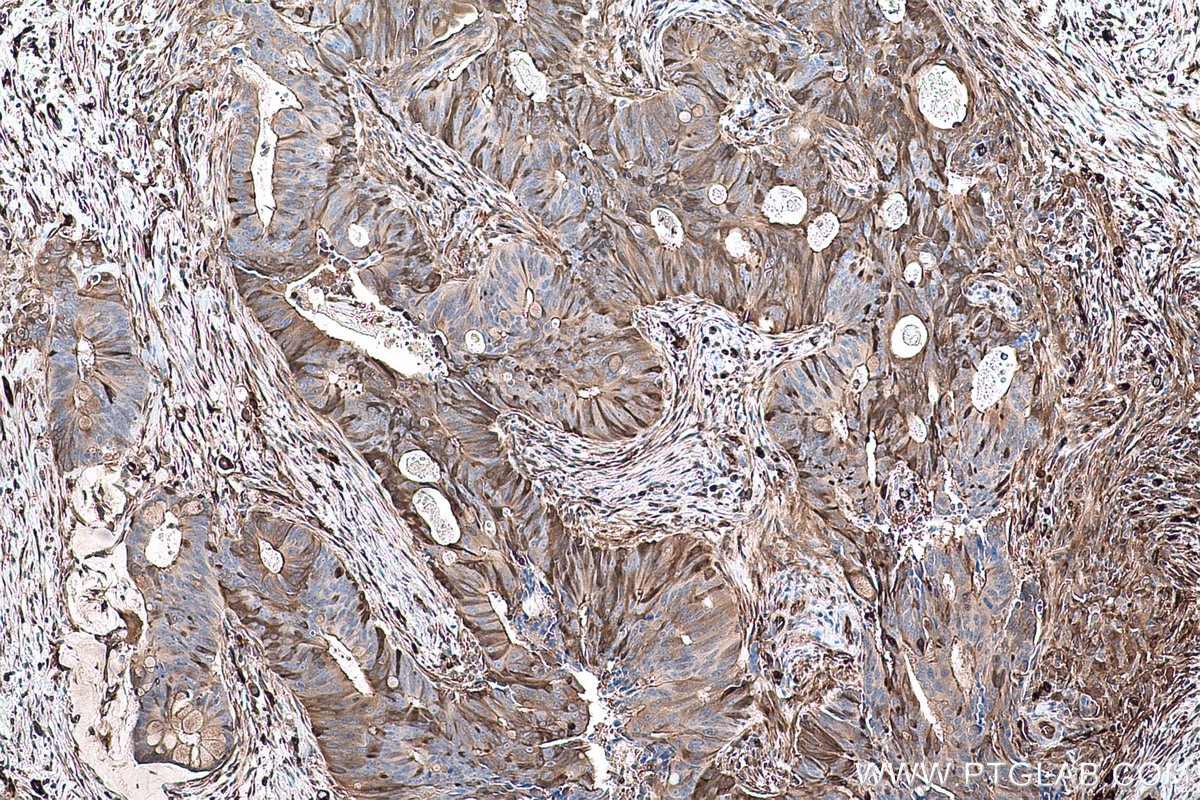 Immunohistochemical analysis of paraffin-embedded human colon cancer tissue slide using KHC0772 (Fascin IHC Kit).