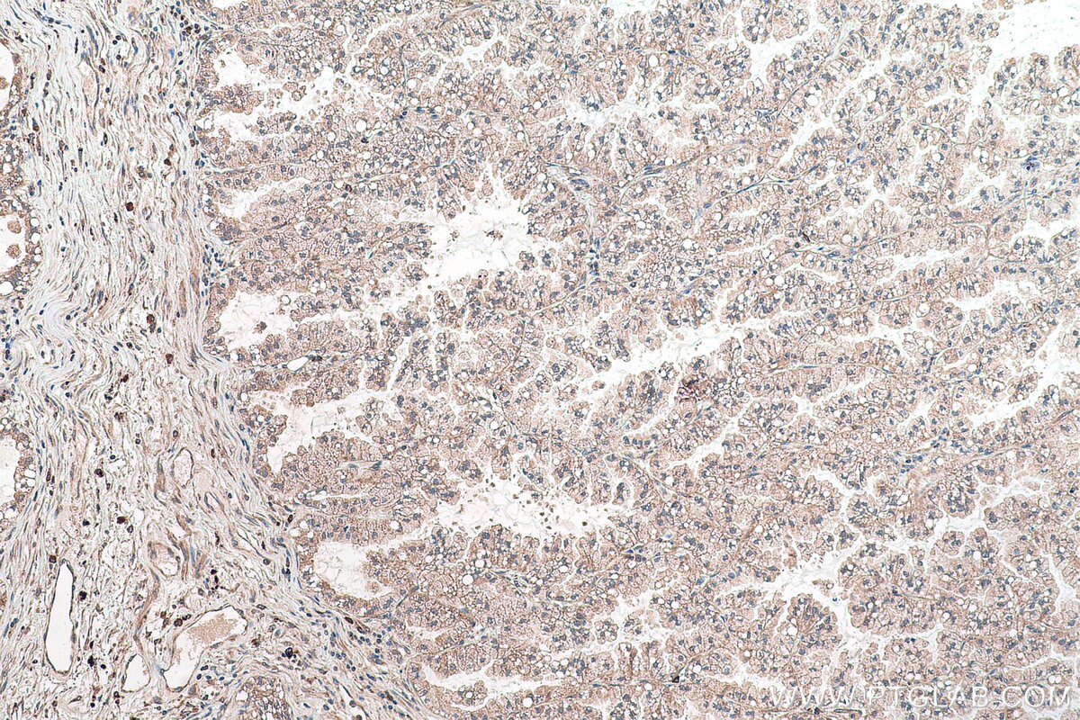 Immunohistochemical analysis of paraffin-embedded human lung cancer tissue slide using KHC0935 (G3BP2 IHC Kit).