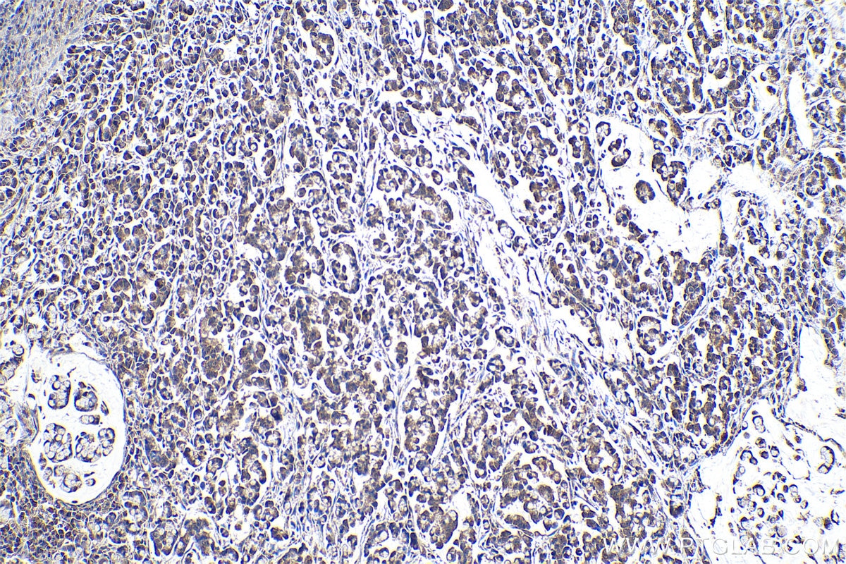 Immunohistochemical analysis of paraffin-embedded human colon cancer tissue slide using KHC0935 (G3BP2 IHC Kit).