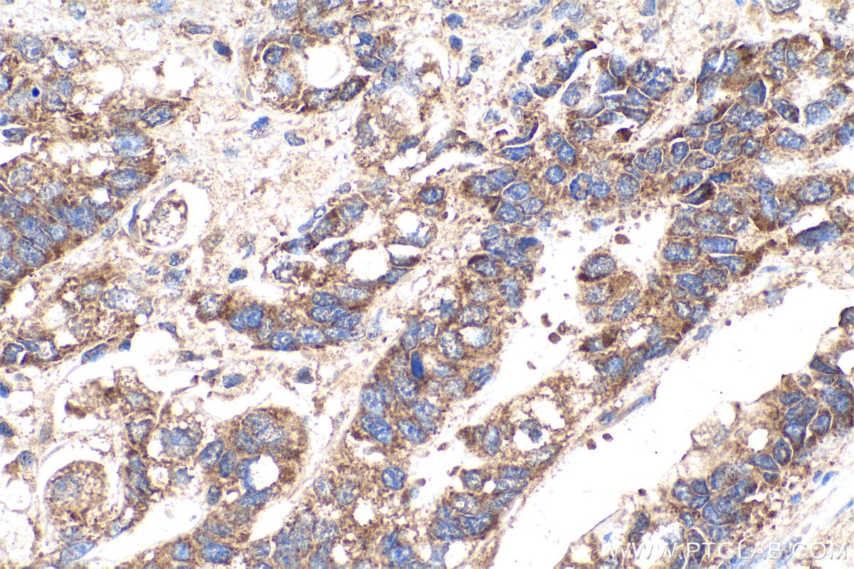 Immunohistochemical analysis of paraffin-embedded human stomach cancer tissue slide using KHC0935 (G3BP2 IHC Kit).